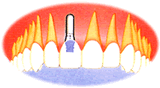 歯を１本失った場合のインプラント