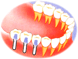 多くの歯を失った場合のインプラント