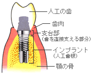 インプラントの構造