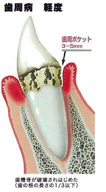 歯周病　軽度