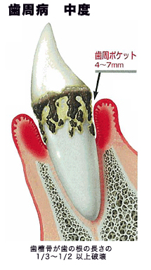 歯周病　中度