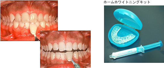 ホワイトニング